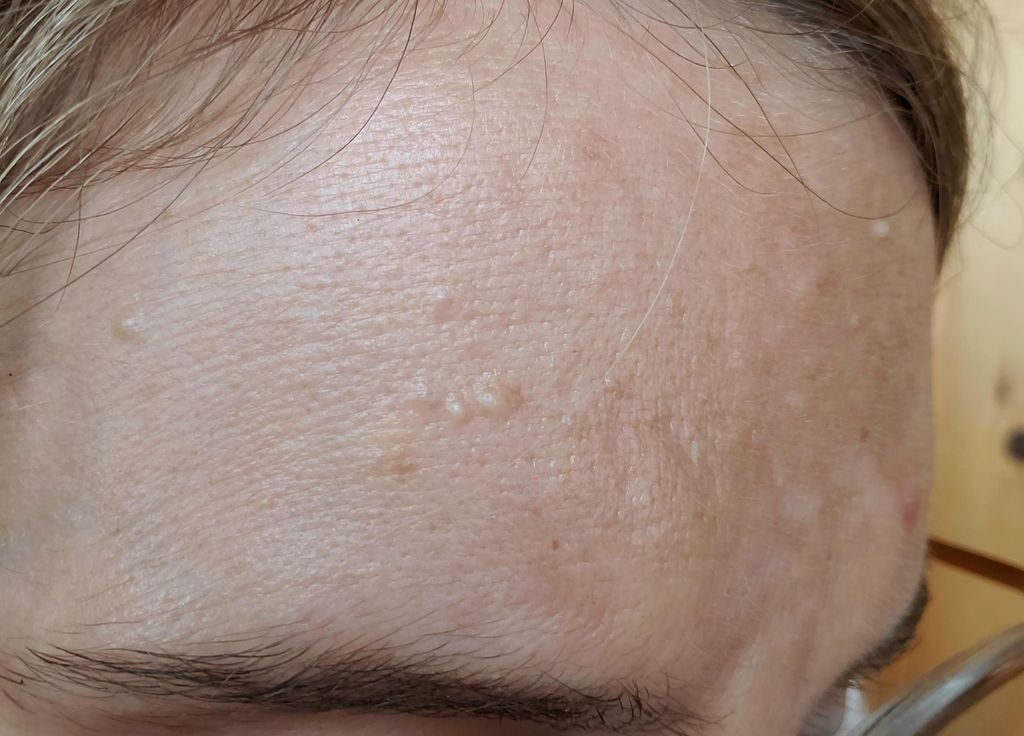 Hyperplasie Sebacee